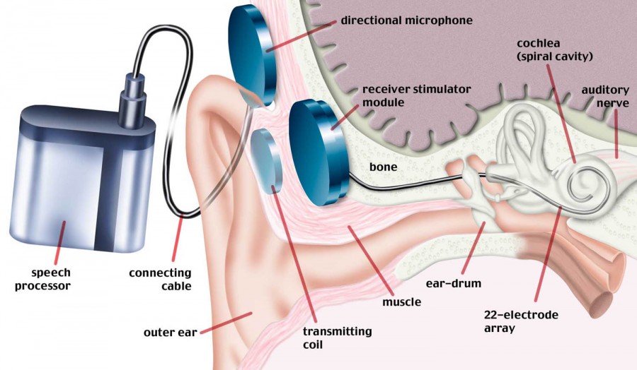 Bionic-ear
